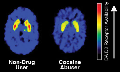 An image of a non-drug user brain beside a drug-user brain